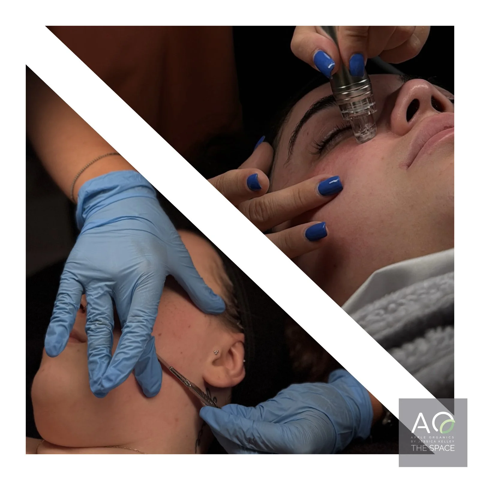 Dermaplaning vs. HydroDiamond Facial: Which Is Right for You?