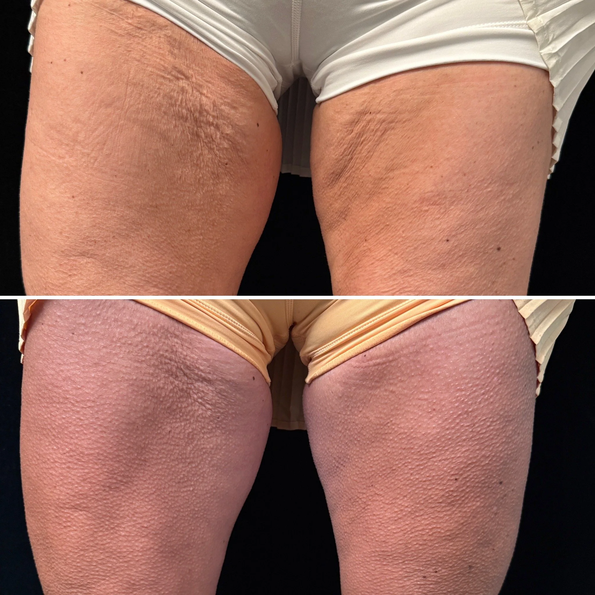 Cutera TruSculpt Before and 12 Weeks After. Will Continue To Improve For Up To 1 Year