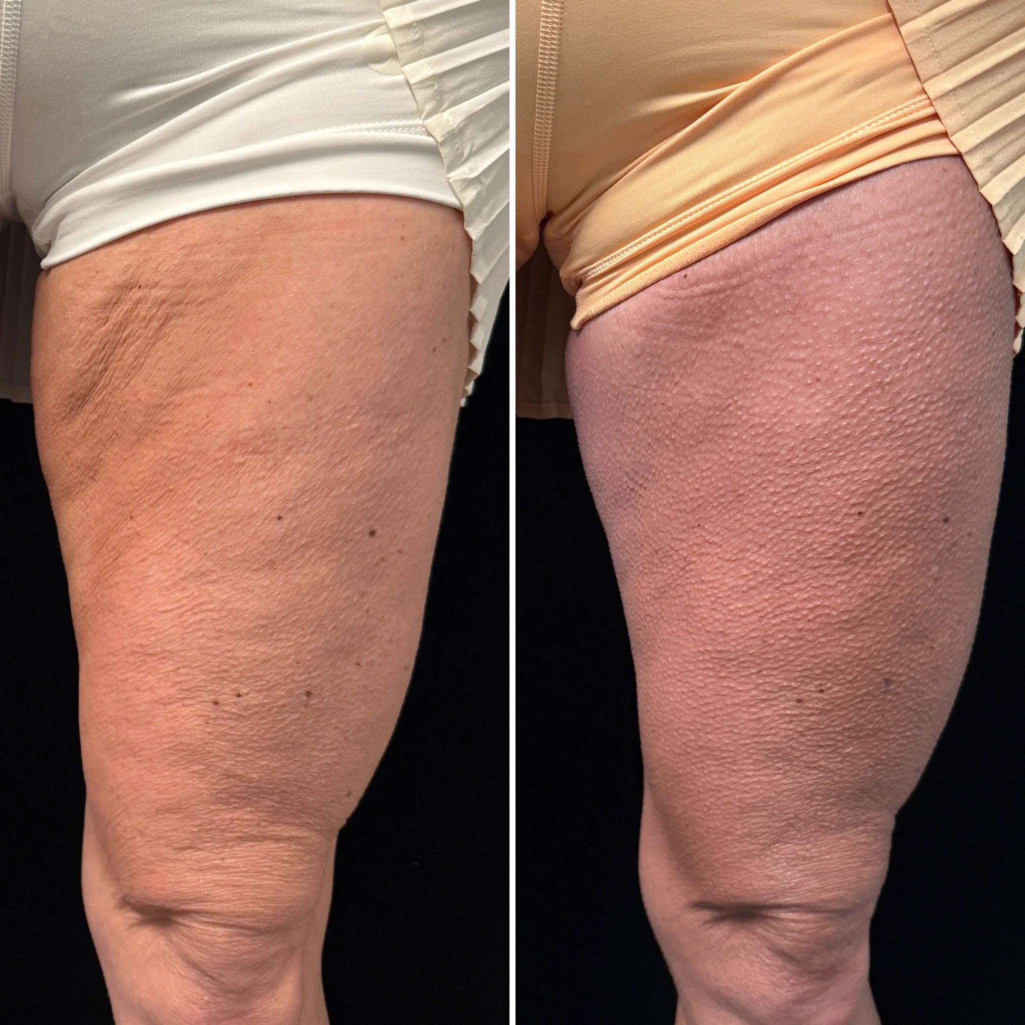 Cutera TruSculpt Before and 12 Weeks After. Will Continue To Improve For Up To 1 Year