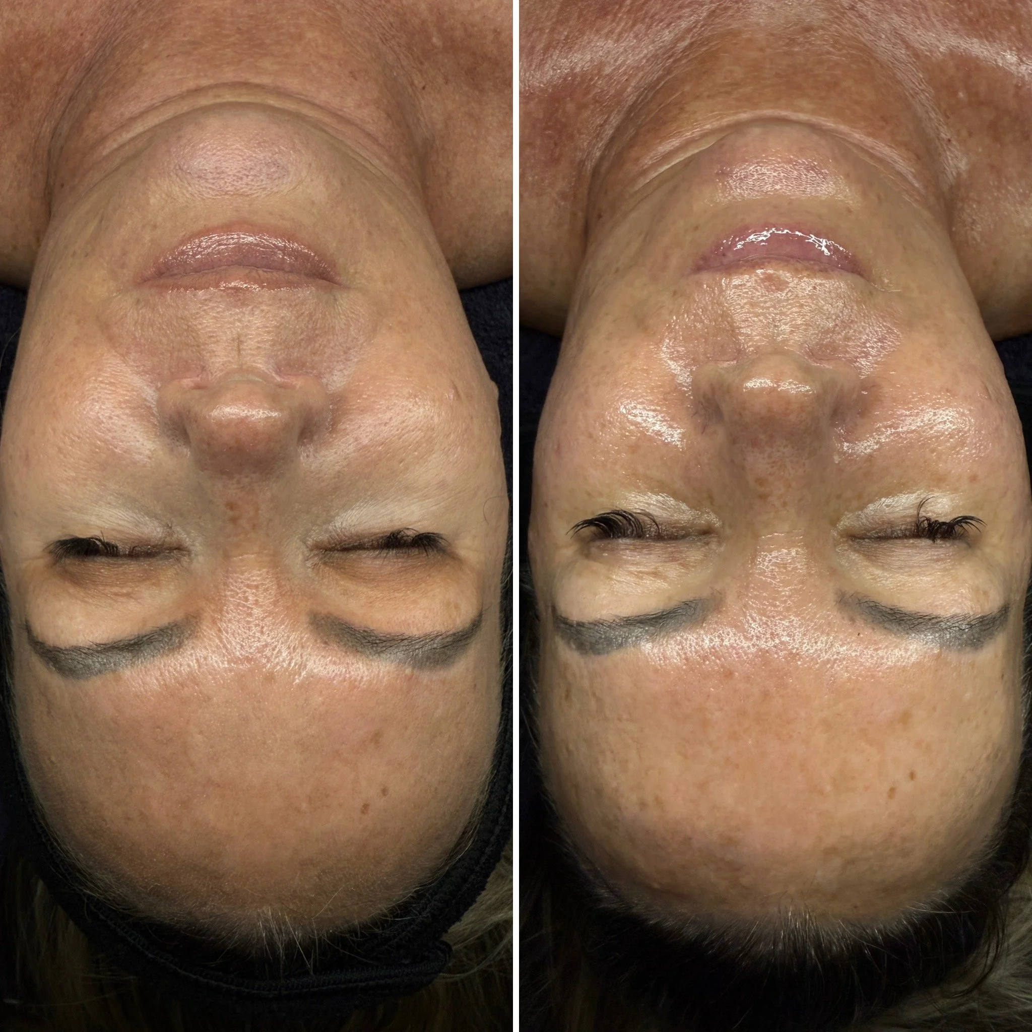 Level 5: The Signature Luxe Facial (notice the amount of inflammation alleviated, especially around the jawline)