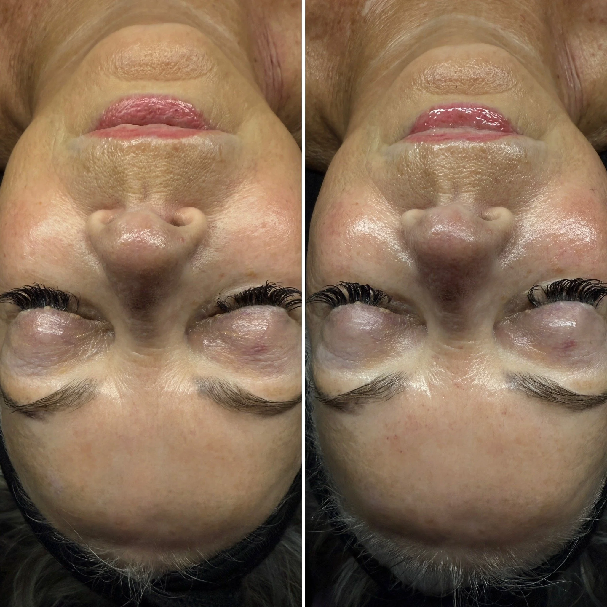 Level 5: The Signature Luxe Facial (notice the amount of inflammation alleviated, especially around the jawline)