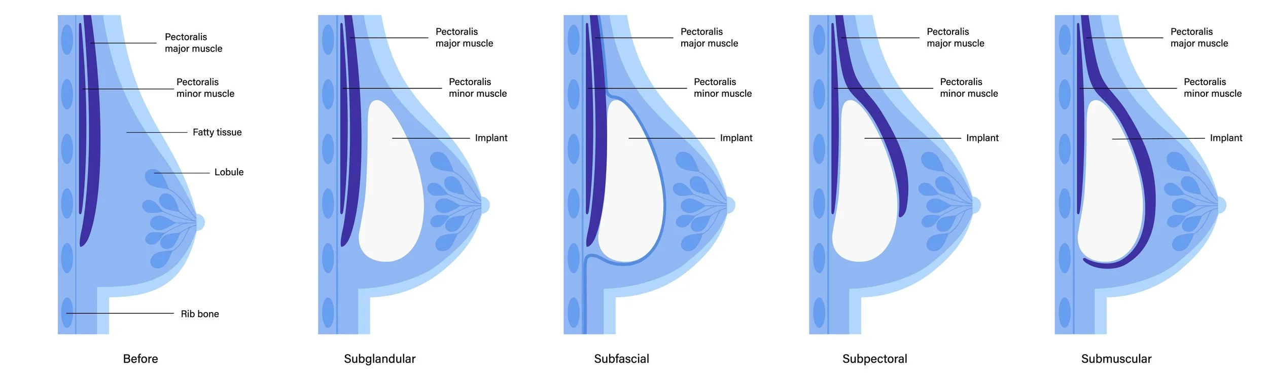 Breast Implants in Vaughan Breast Augmentation GTA Valespring