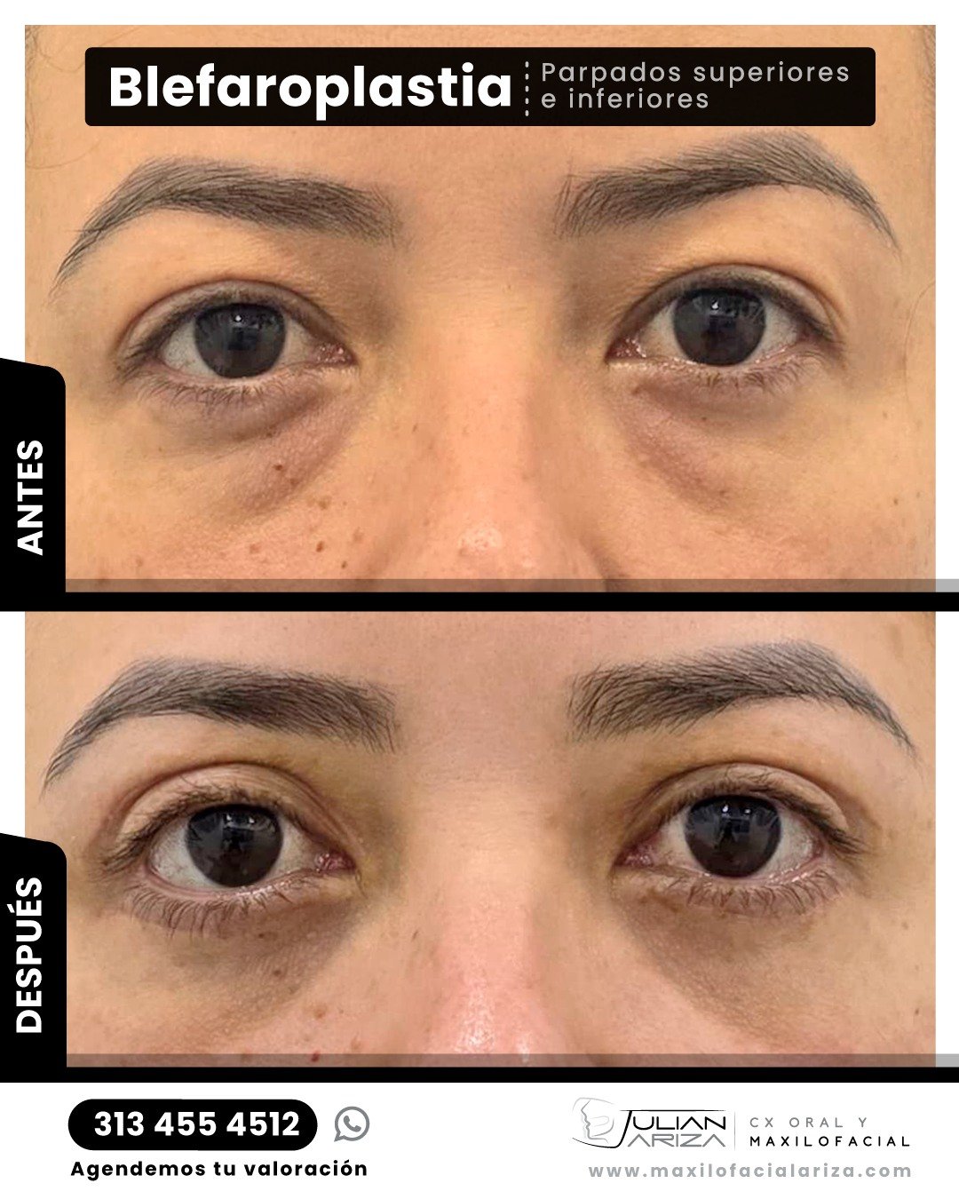 &iquest;Sab&iacute;as que los p&aacute;rpados son una de las primeras zonas que muestran signos de envejecimiento? 👁️

El Dr. Julian Ariza realiza la blefaroplastia (Superior e inferior), un procedimiento que elimina el exceso de piel y grasa en los
