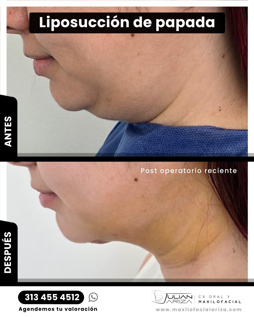 &iquest;Cansada de esa molesta acumulaci&oacute;n de grasa bajo tu ment&oacute;n? La lipopapada es la soluci&oacute;n ideal para eliminar la papada y definir tu rostro.

&iquest;Qu&eacute; es la lipopapada?
La lipopapada es una t&eacute;cnica de ciru