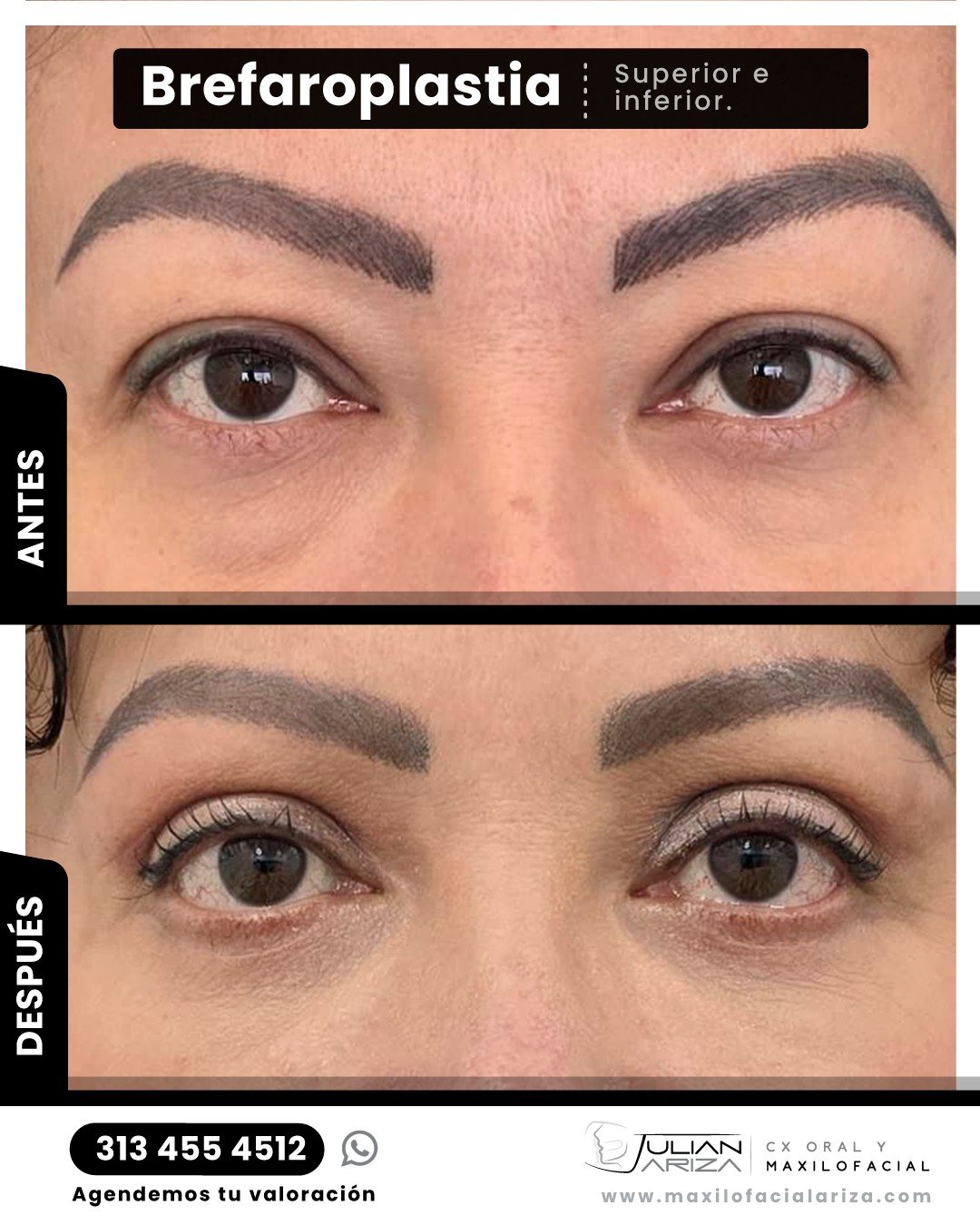 &iquest;Sab&iacute;as que los p&aacute;rpados son una de las primeras zonas que muestran signos de envejecimiento? 👁️
El Dr. Julian Ariza realiza la blefaroplastia (Superior e inferior), un procedimiento que elimina el exceso de piel y grasa en los 