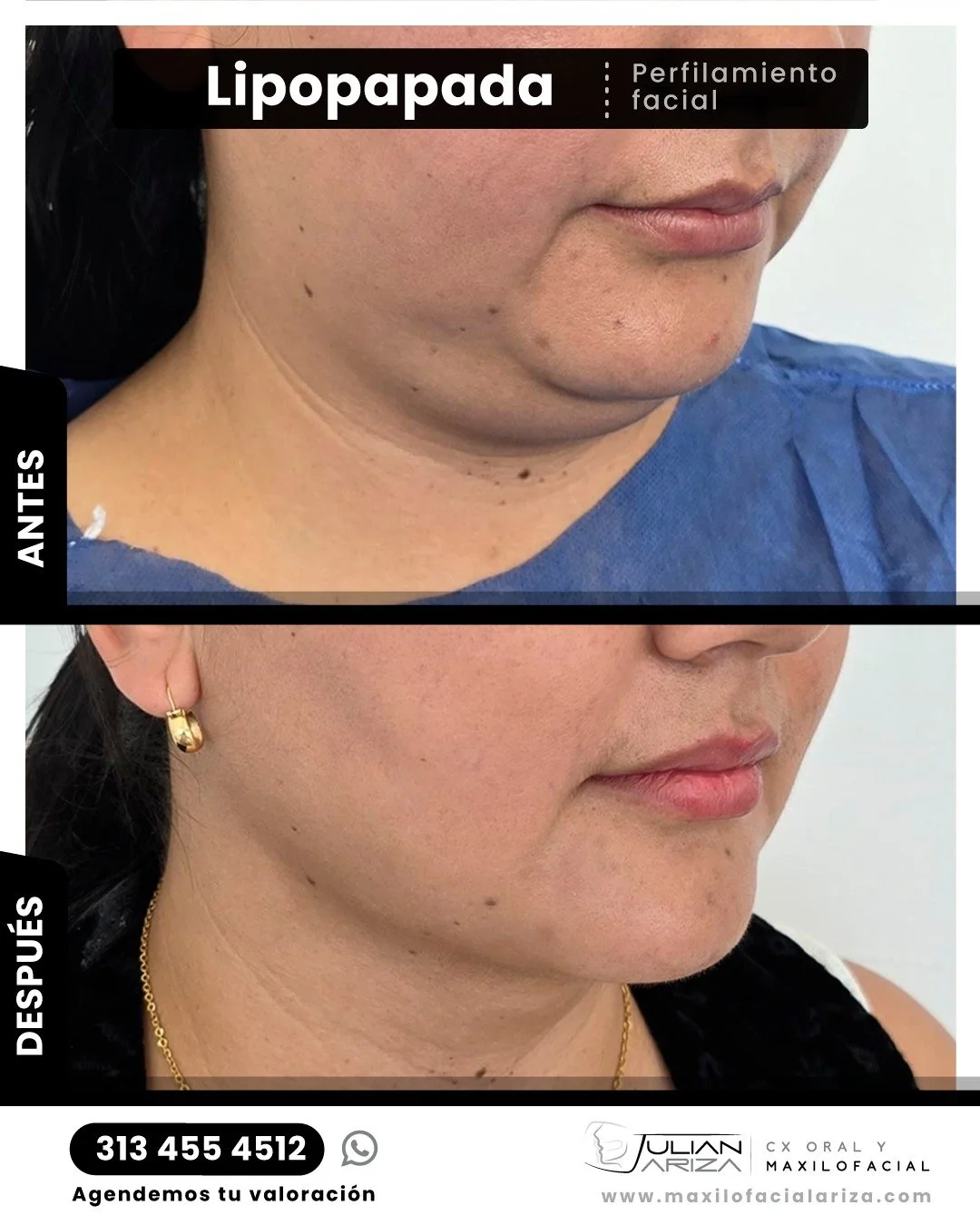 &iquest;Se puede realizar la lipopapada con sobrepeso?

En principio, s&iacute; es posible realizar una lipopapada en pacientes con sobrepeso, aunque con importantes matices y consideraciones . La decisi&oacute;n depender&aacute; de varios factores q