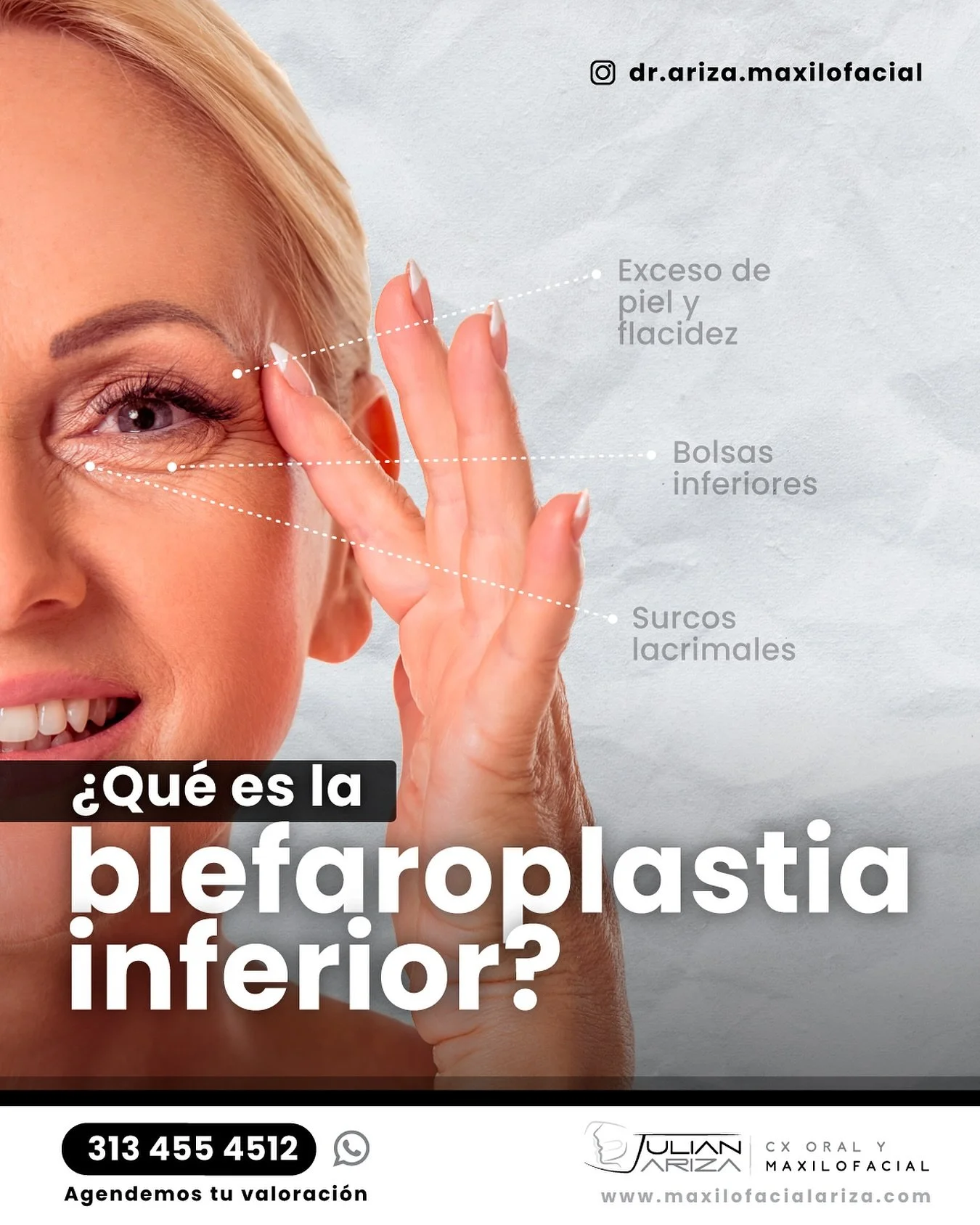 La blefaroplastia inferior es un procedimiento quir&uacute;rgico dise&ntilde;ado para rejuvenecer el aspecto de los p&aacute;rpados inferiores, corrigiendo problemas est&eacute;ticos como:

Bolsas bajo los ojos
Exceso de piel y flacidez
Ojeras profun