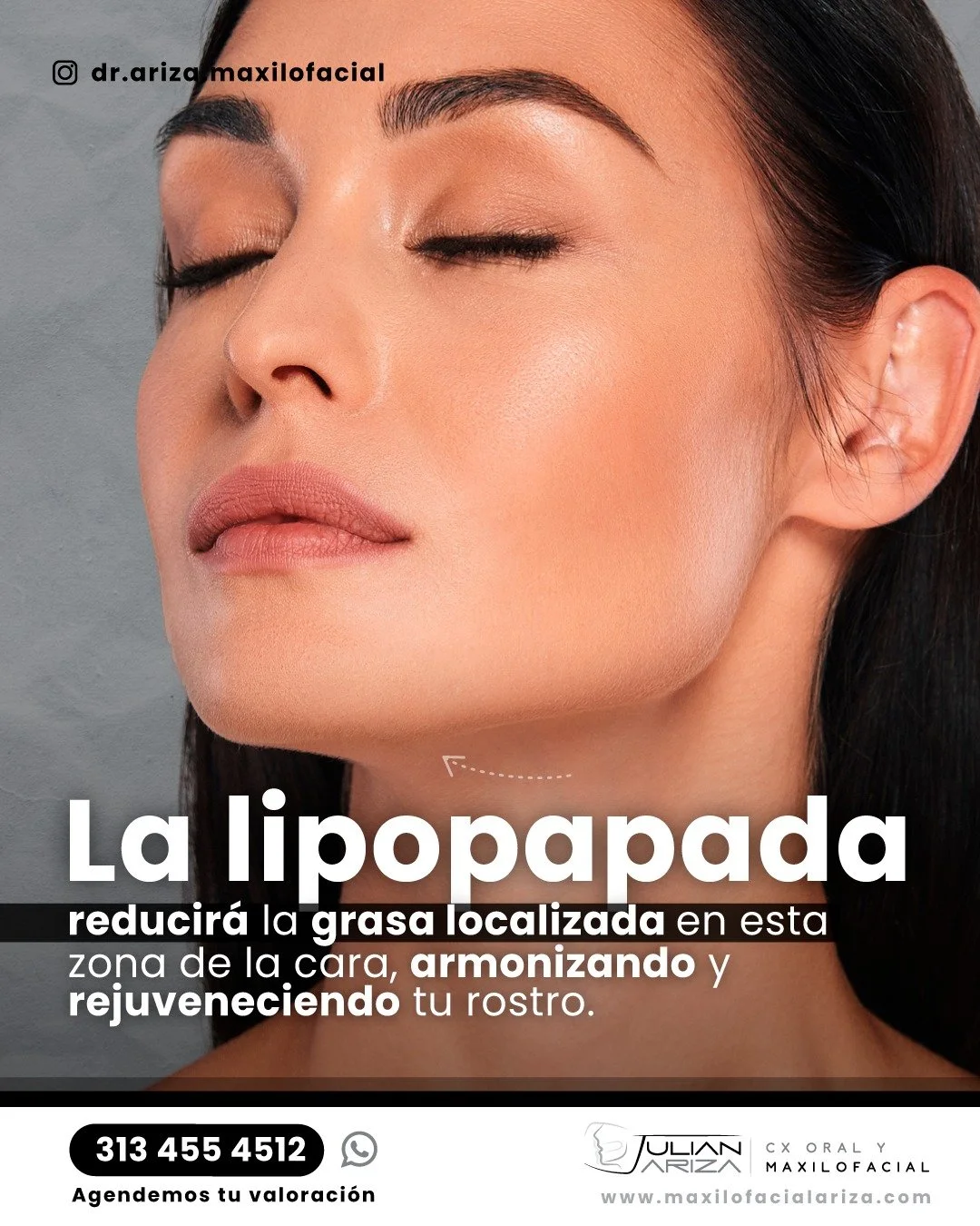 La Lipopapada  busca eliminar el tejido adiposo que se encuentra debajo del contorno mandibular, es un procedimiento muy sencillo, m&iacute;nimamente invasivo y ambulatorio el cual es realizado por un especialista altamente calificado como el Dr. Jul