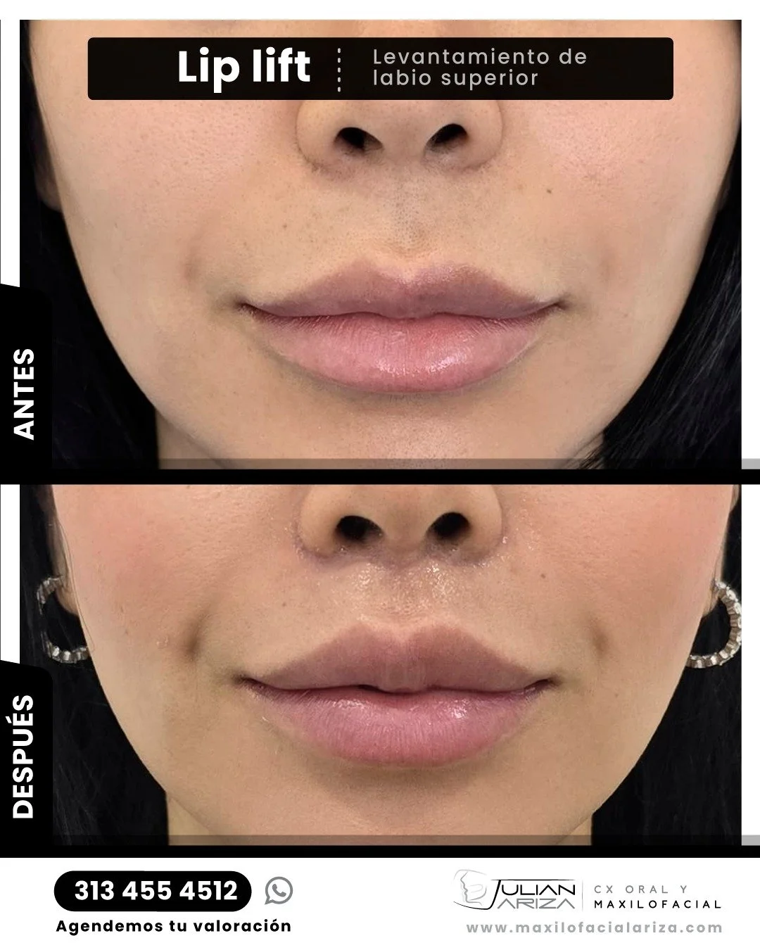 &iquest;Qu&eacute; es el Lip Lift?

El lip lift es un procedimiento quir&uacute;rgico est&eacute;tico menor que tiene como objetivo acortar la distancia entre la base de la nariz y el borde del labio superior, mejorando significativamente la aparienc