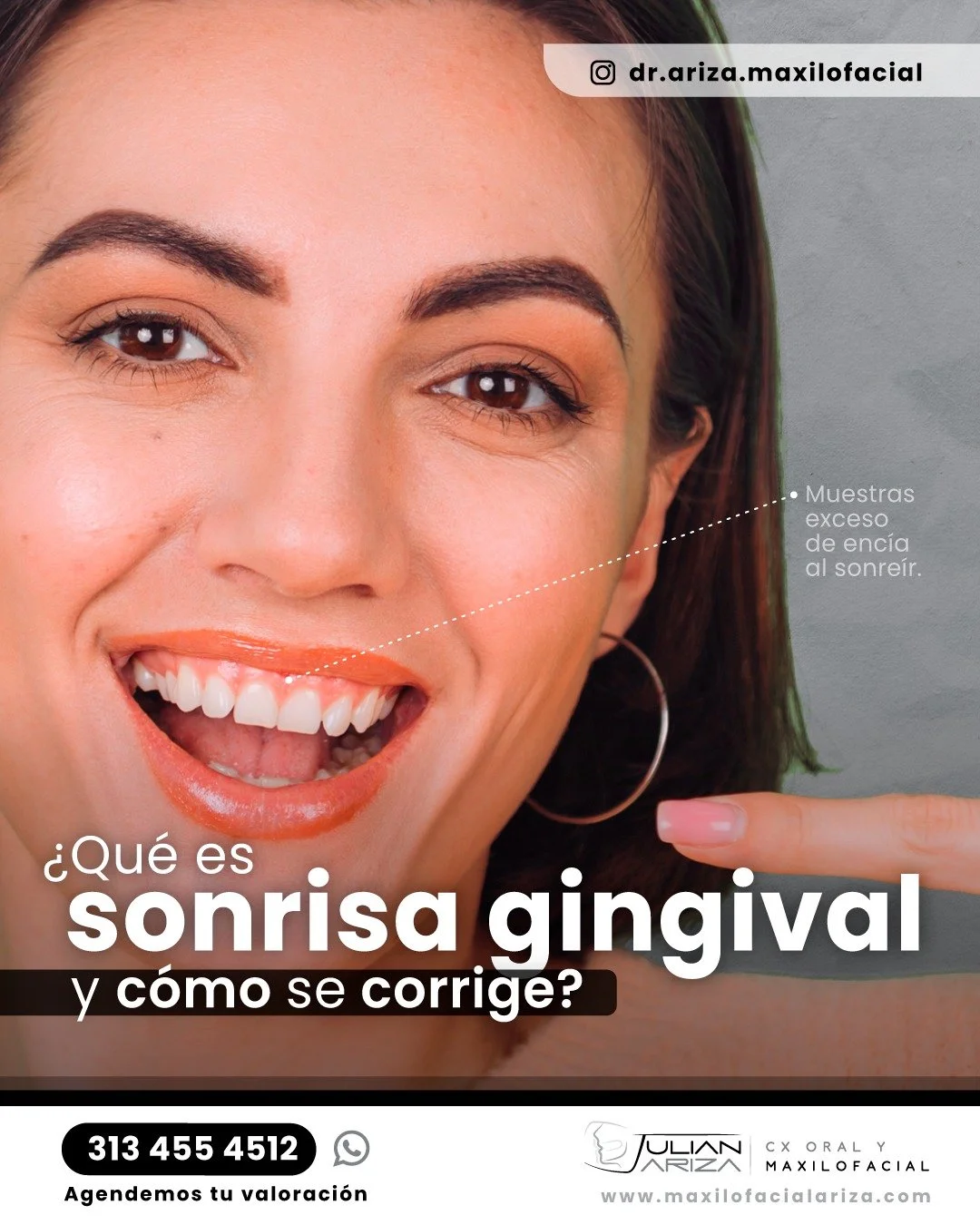 La sonrisa gingival es una condici&oacute;n est&eacute;tica en la que se muestra una cantidad excesiva de enc&iacute;a al sonre&iacute;r, generalmente m&aacute;s de 2-3 mil&iacute;metros. 

Esta situaci&oacute;n puede hacer que los dientes se vean m&