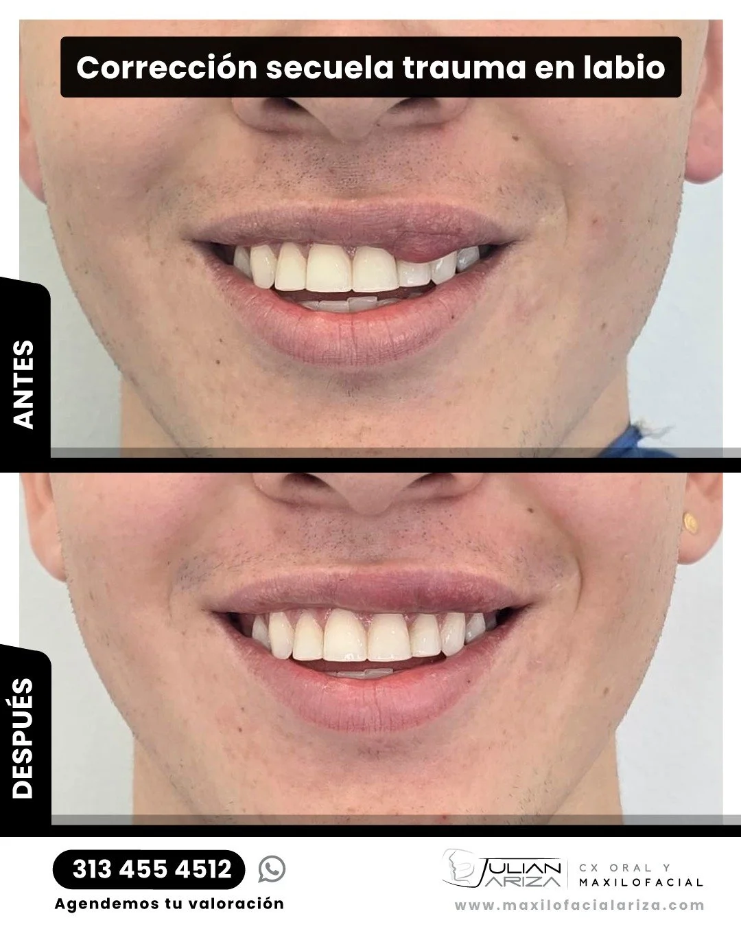 Transforma las secuelas en sonrisas naturales 
&iquest;qu&eacute; corregimos?
📌 cicatrices antiest&eacute;ticas por accidentes
📌 asimetr&iacute;as labiales
📌 p&eacute;rdida de volumen o forma
📌 dificultades funcionales (habla/alimentaci&oacute;n)