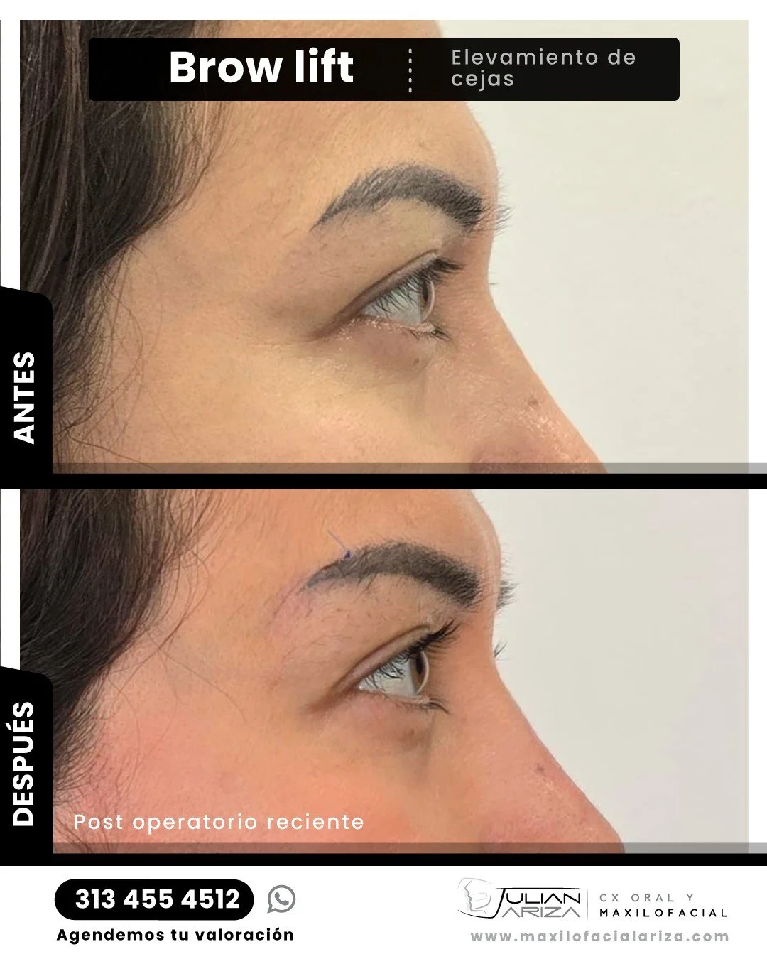 El brow Lift o elevaci&oacute;n de cejas puede cambiar tu rostro y rejuvenecer tu expresi&oacute;n en un abrir y cerrar de ojos. Descubre c&oacute;mo el lifting de cejas puede abrir las puertas a una mirada m&aacute;s en&eacute;rgica y radiante.

El 