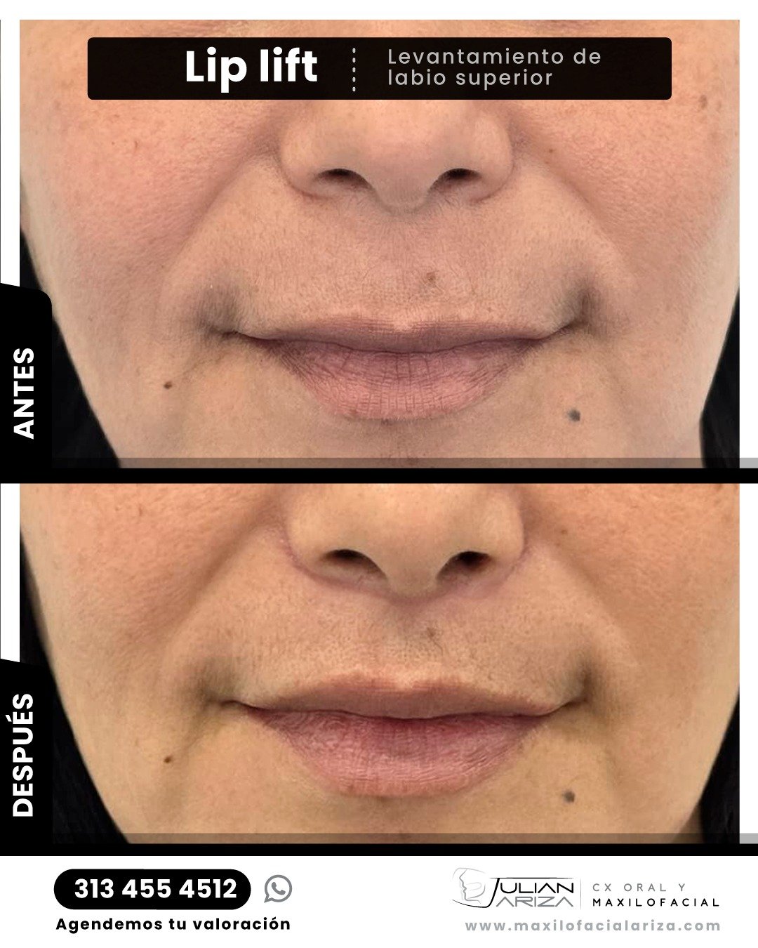 &iquest;Qu&eacute; es el Lis lift?

El lip lift es un procedimiento quir&uacute;rgico est&eacute;tico menor que tiene como objetivo acortar la distancia entre la base de la nariz y el borde del labio superior, mejorando significativamente la aparienc