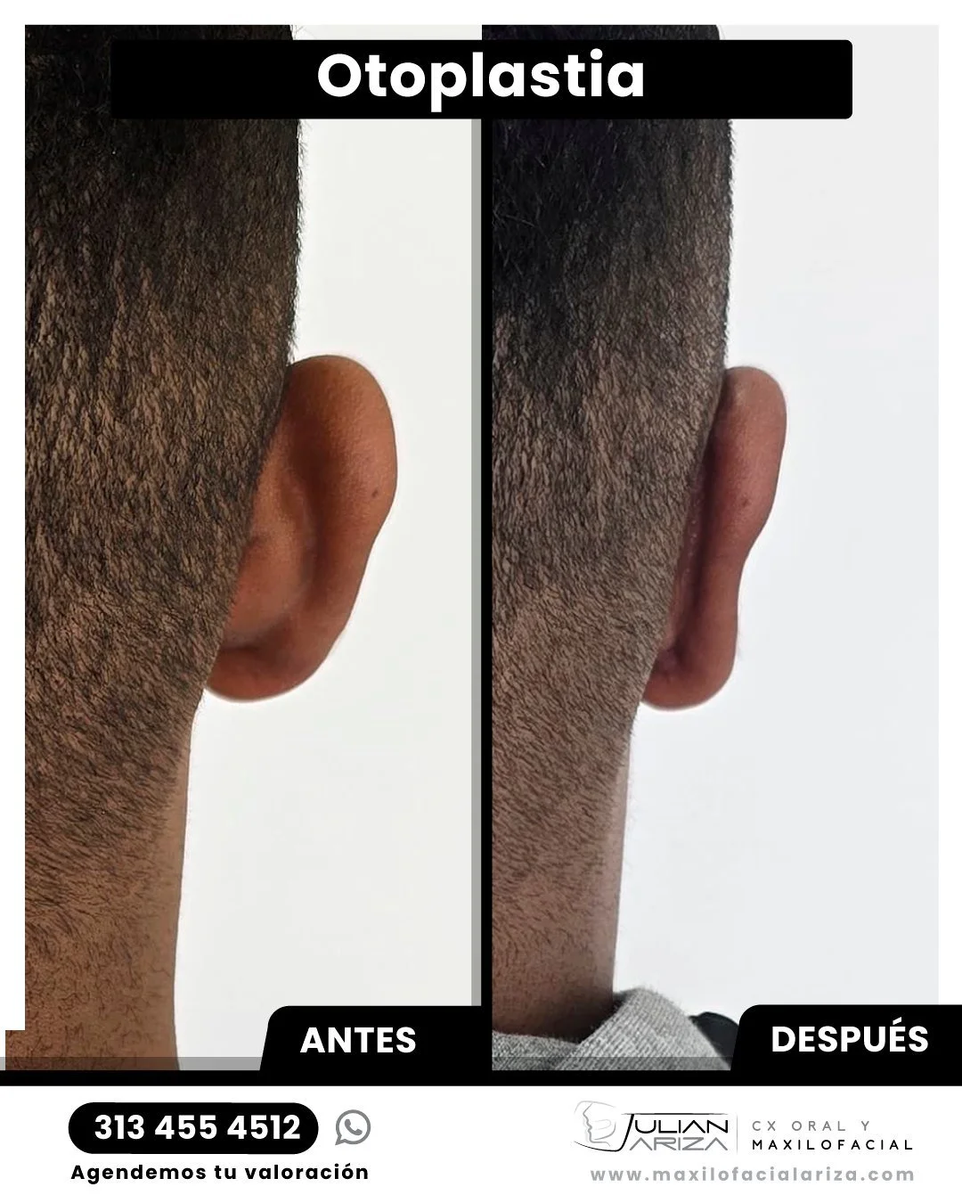 Problemas que Corrige la Otoplastia
Problemas M&aacute;s Comunes:
1. Orejas Prominentes o Separadas ⭐ (El m&aacute;s frecuente)
Orejas que sobresalen demasiado de la cabeza
Se corrige plegando y reposicionando el cart&iacute;lago

2. Orejas Grandes (