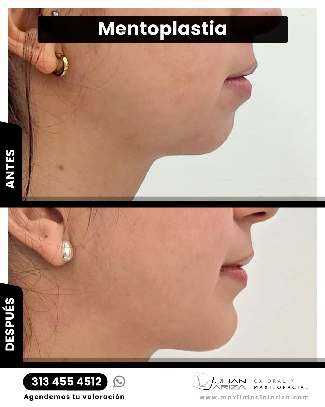 Una mentoplastia se realiza dependiendo del caso o tipo de paciente; en la cita de valoraci&oacute;n, el Dr. Julian Ariza Maxilofacial determina el tipo de t&eacute;cnica a realizar que puede ser osea o colocando implantes (En casos muy espec&iacute;