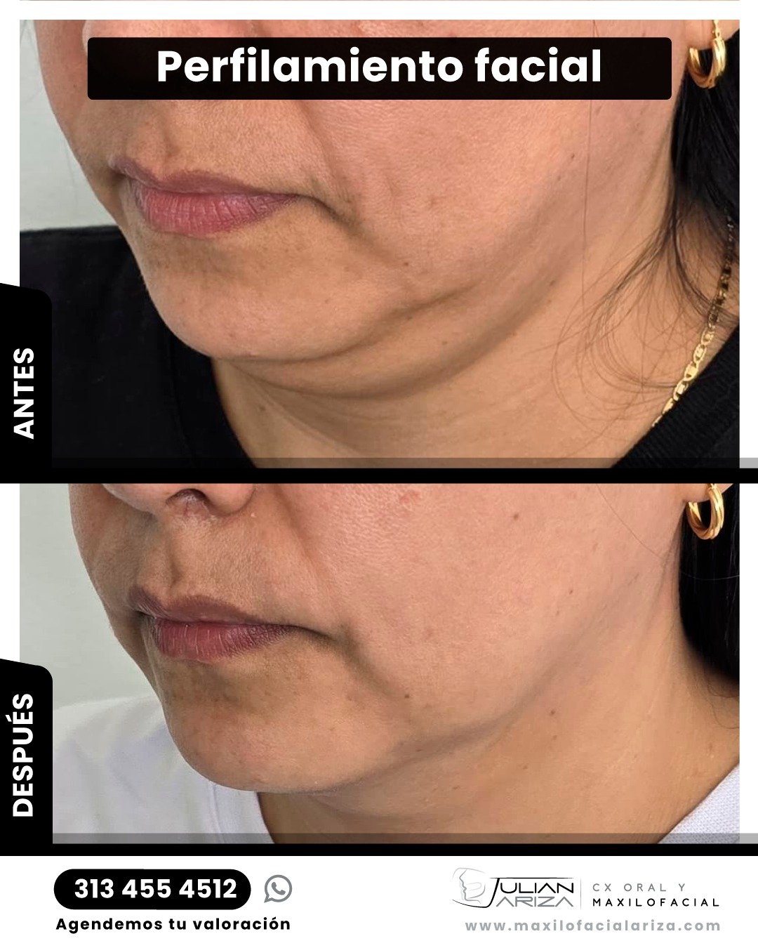 El perfilamiento facial y el lifting facial son procedimientos est&eacute;ticos que se diferencian en sus objetivos y t&eacute;cnicas:

1. Perfilamiento facial
Se trata de un conjunto de procedimientos quir&uacute;rgicos que buscan mejorar el contorn