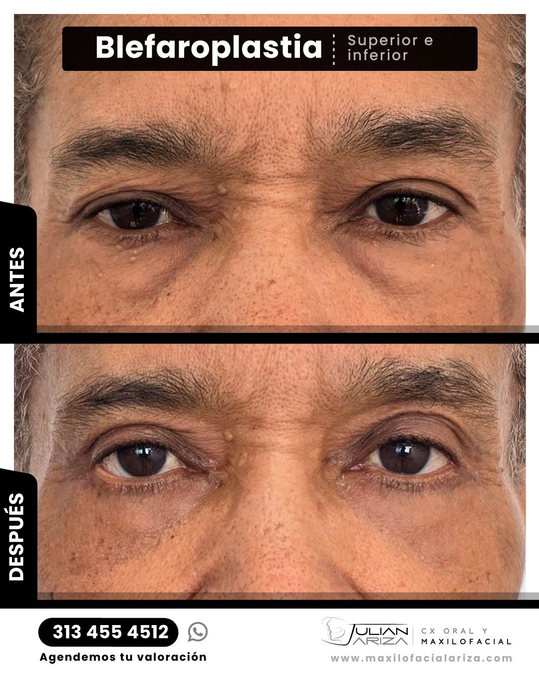 &iquest;Que es lo que realmente hace la blefaroplastia?

1.Elimina el exceso de piel y grasa: La cirug&iacute;a retira tejido sobrante de los p&aacute;rpados, haciendo que los ojos parezcan m&aacute;s abiertos y menos cansados. 
2.Rejuvenece la mirad