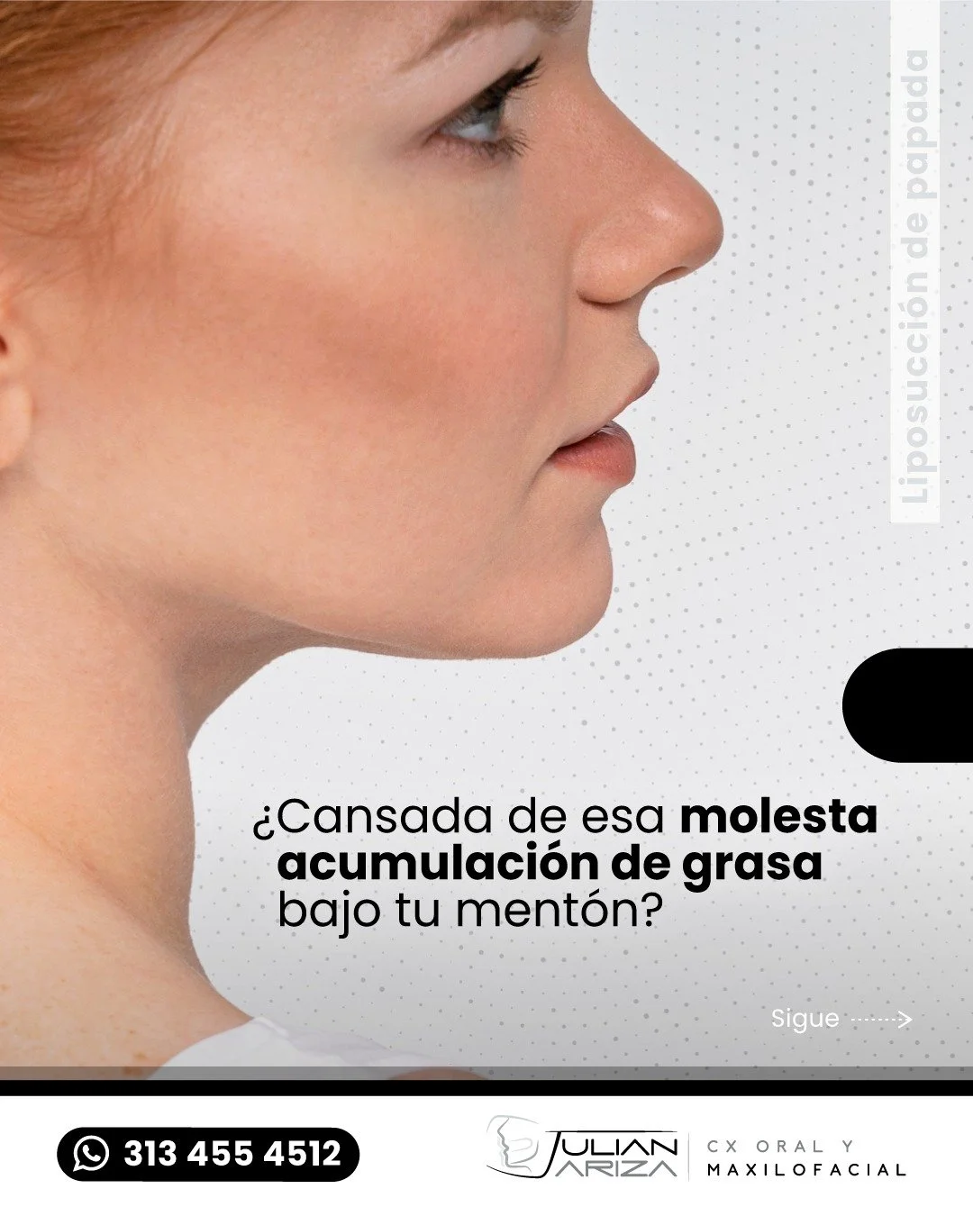 &iquest;Qu&eacute; es la lipopapada?
La lipopapada es una t&eacute;cnica de cirug&iacute;a est&eacute;tica que consiste en la eliminaci&oacute;n de la grasa localizada debajo del ment&oacute;n mediante liposucci&oacute;n. Se realiza a trav&eacute;s d