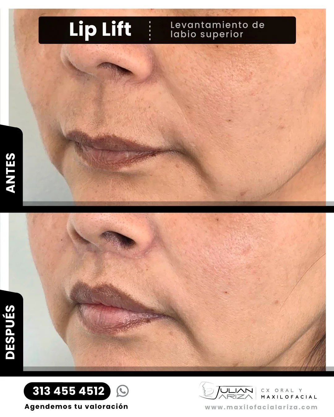 A medida que envejecemos, la elasticidad de la piel y sus sustancias de apoyo se deterioran. Esto resulta en labios desinflados y estrechos con l&iacute;neas finas y esquinas arrancadas, produciendo una apariencia enojada y envejecida.
Los labios son