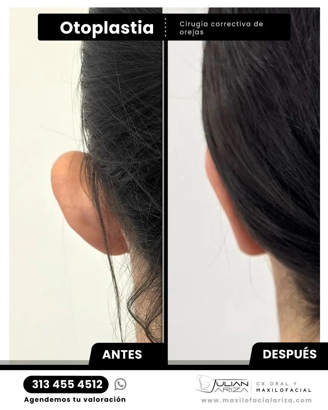 La otoplastia es una cirug&iacute;a facial cuyo objetivo es corregir la separaci&oacute;n excesiva de las orejas y/o el tama&ntilde;o desproporcionado de las mismas respecto a la cabeza. La otoplastia m&aacute;s com&uacute;n y la m&aacute;s solicitad