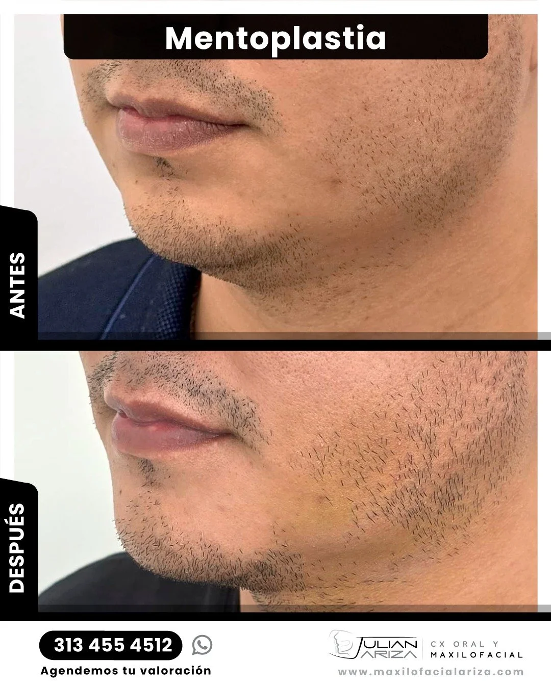 El ment&oacute;n juega un papel cr&iacute;tico en la percepci&oacute;n est&eacute;tica de la cara. Debido a su ubicaci&oacute;n relativamente central, el ment&oacute;n, junto con la nariz, afecta al balance general y el atractivo del frente y del per