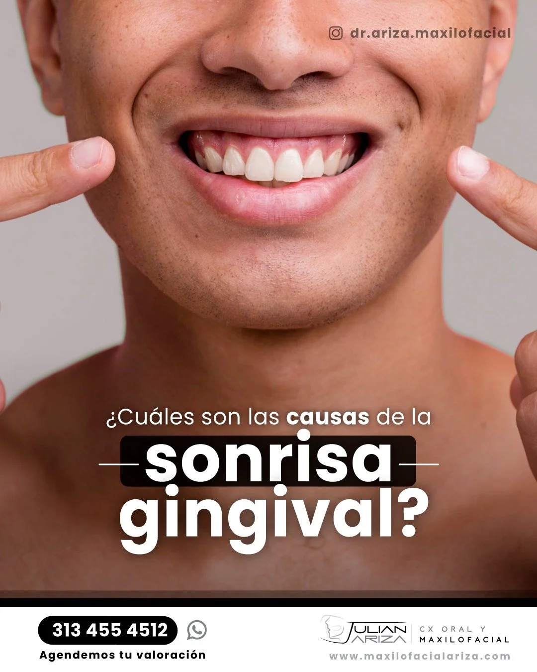 &iquest;Qu&eacute; es la sonrisa gingival?
-Es una condici&oacute;n en la que se muestra exceso de enc&iacute;a al sonre&iacute;r (m&aacute;s de 3-4 mm)
-Tambi&eacute;n conocida como ""sonrisa alta"" o ""sonrisa con expo