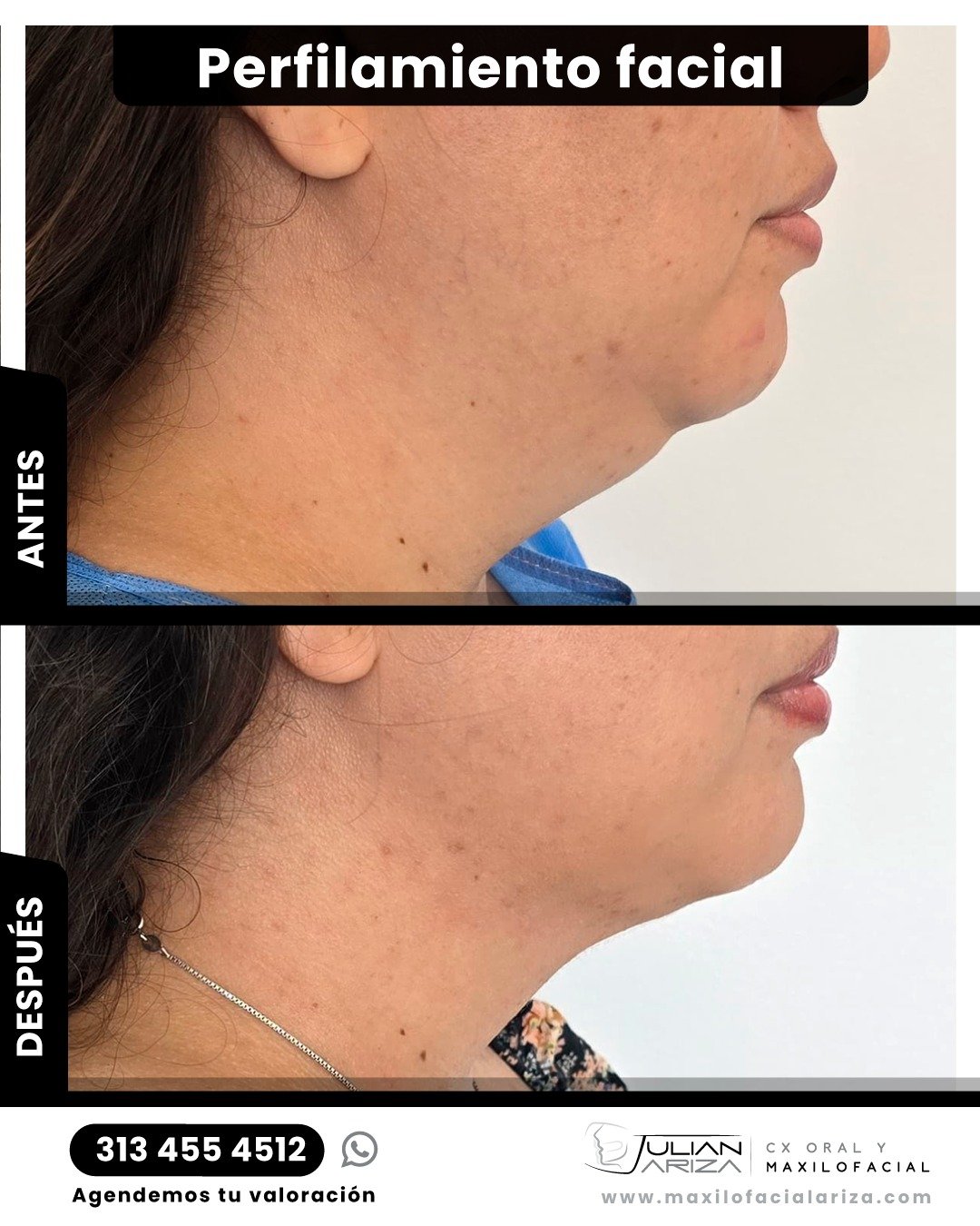 El perfilamiento facial es un conjunto de cirug&iacute;as que se utiliza para corregir las facciones que m&aacute;s resaltan en el perfil de cada persona y que una vez remodeladas adquieren una forma proporcionada con el resto de las facciones lucien