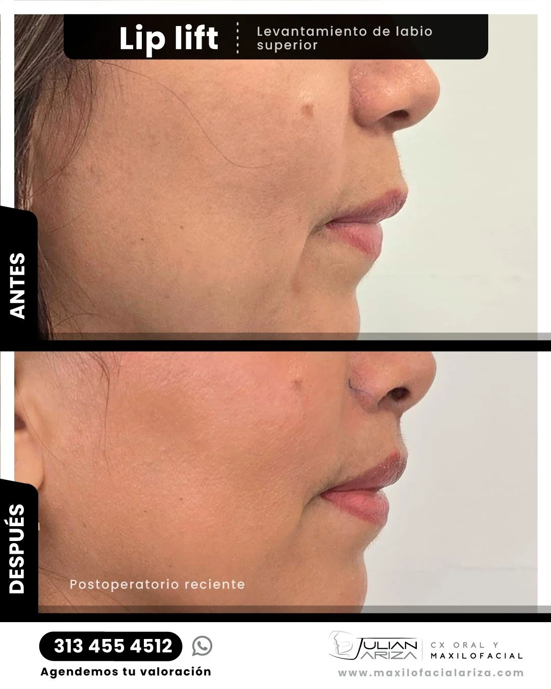 A medida que envejecemos, la elasticidad de la piel y sus sustancias de apoyo se deterioran. Esto resulta en labios desinflados y estrechos con l&iacute;neas finas y esquinas arrancadas, produciendo una apariencia enojada y envejecida.
Los labios son