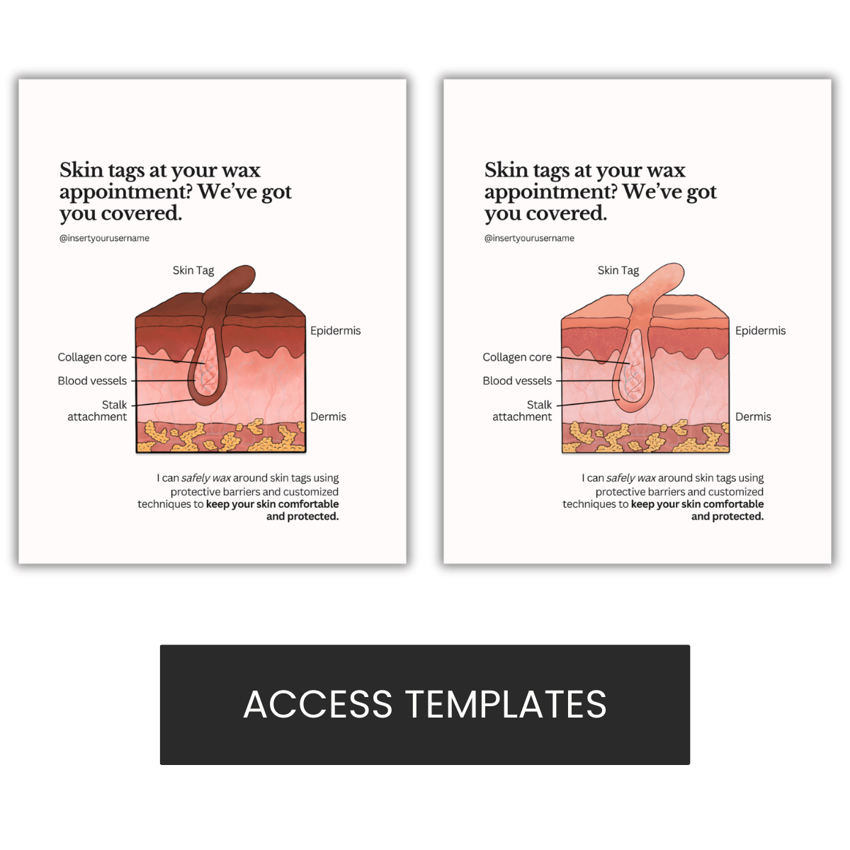 Skin Tag Illustration
