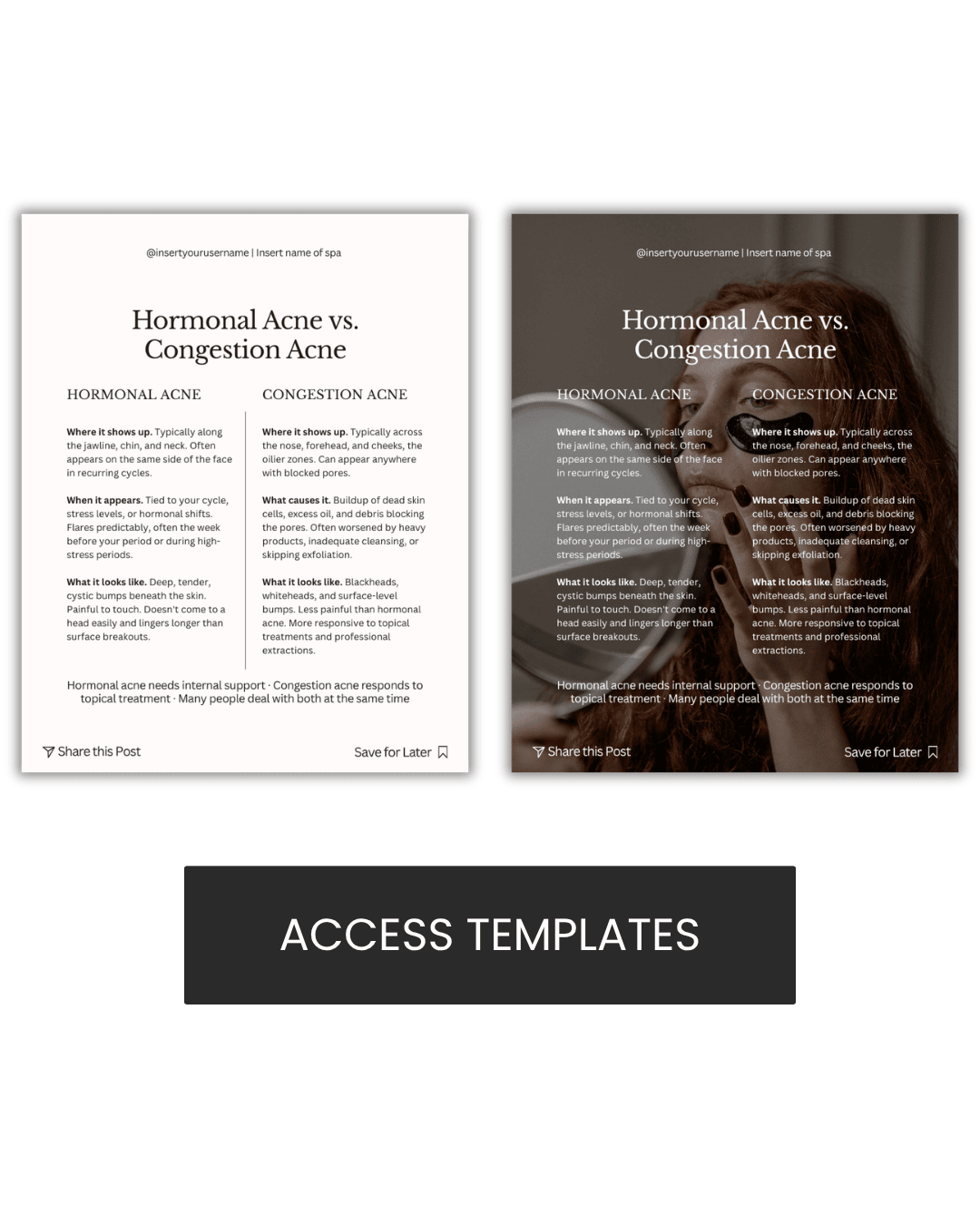 Hormonal Acne vs. Congestion Acne Graphic