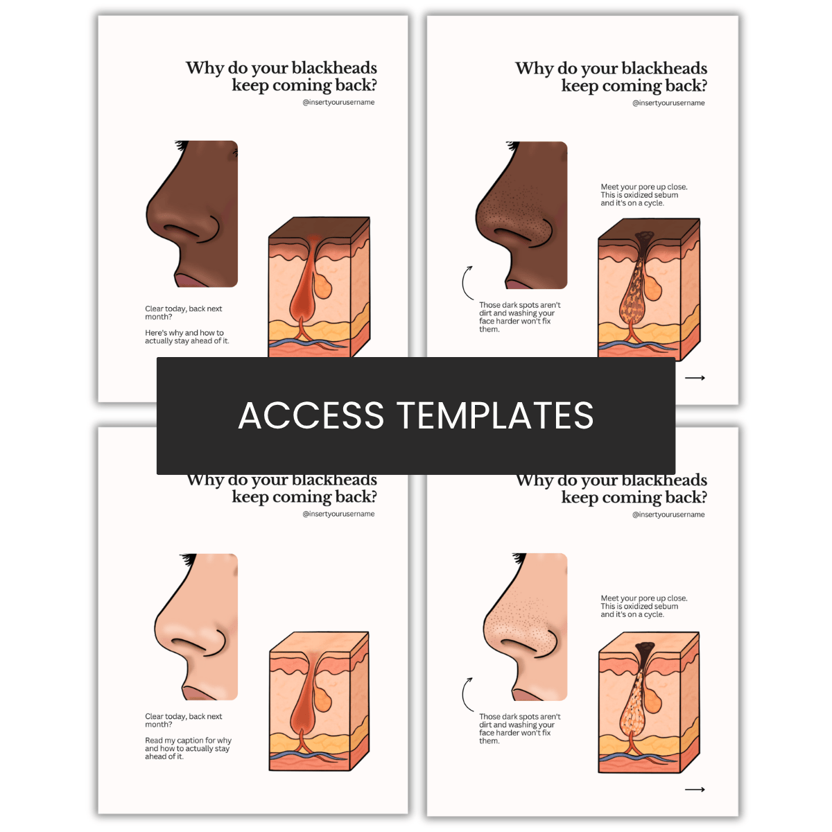 Blackheads Illustration