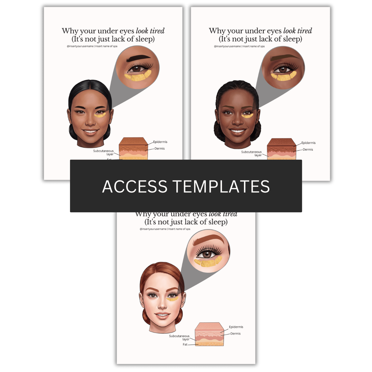 Under eyes fat pad Illustration