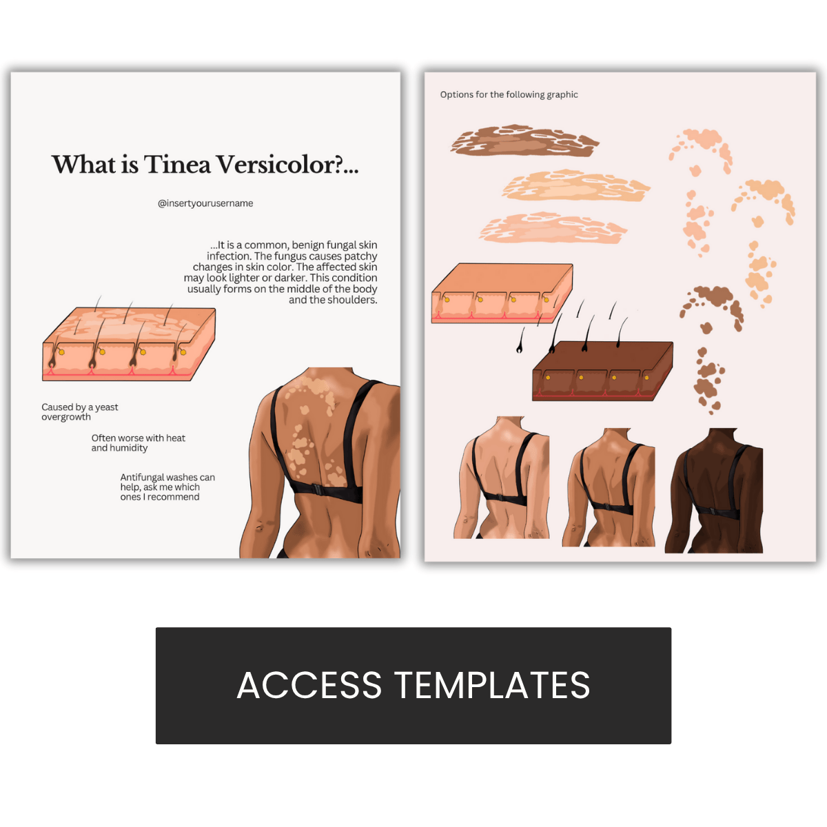 Tinea Versicolor Illustration