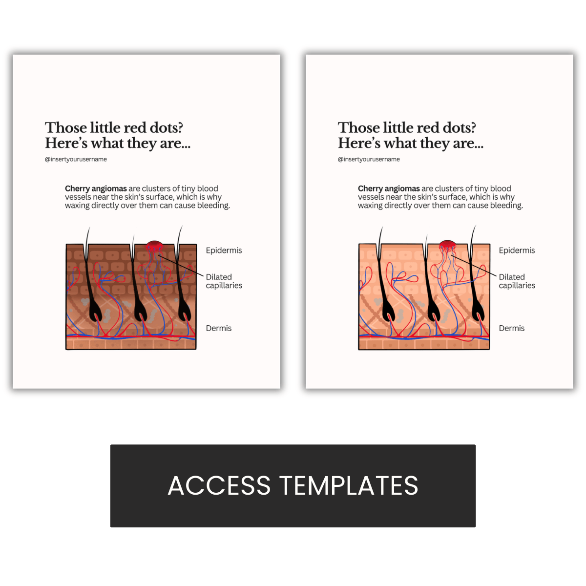 Cherry Angiomas Illustration