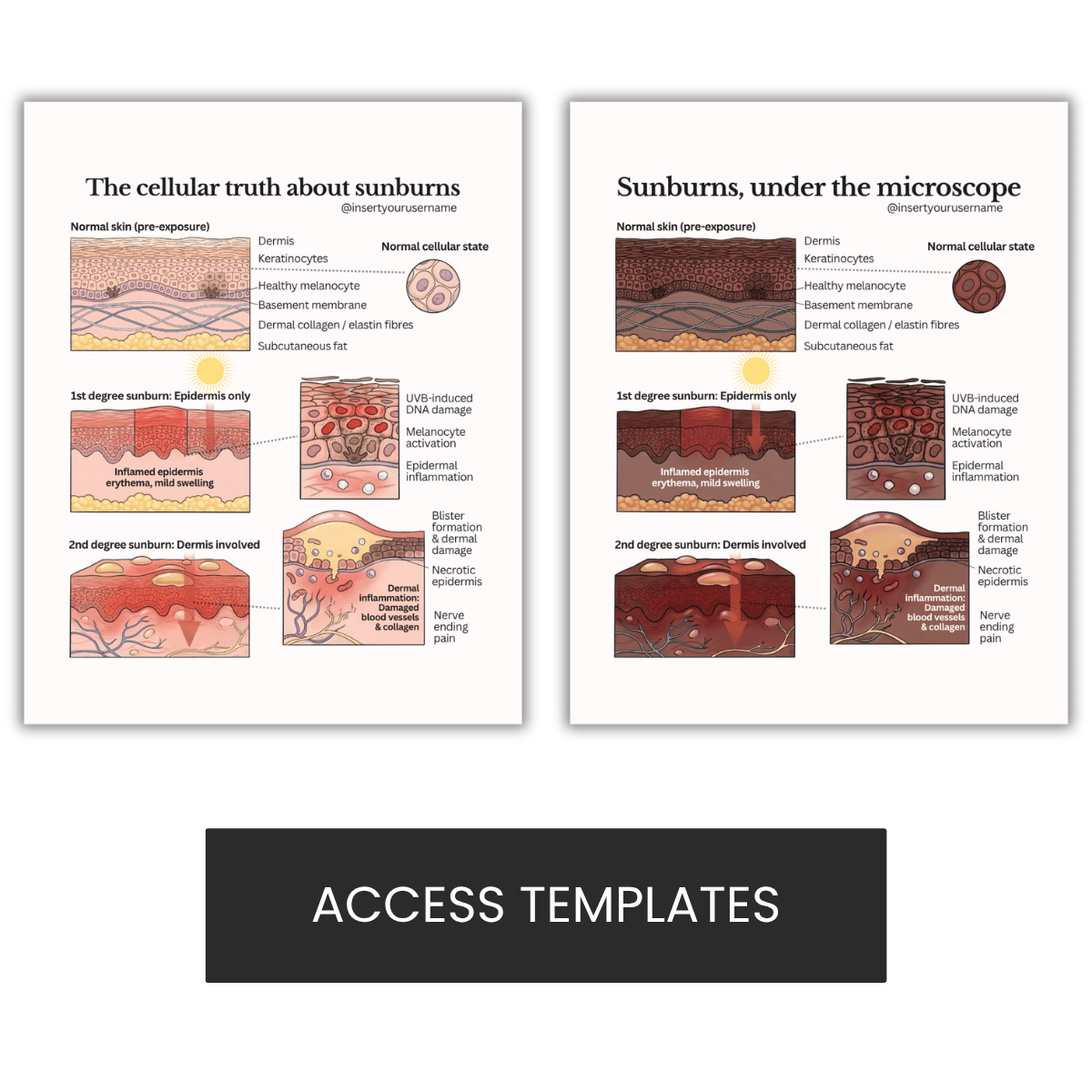 The cellular truth about sunburns Illustration