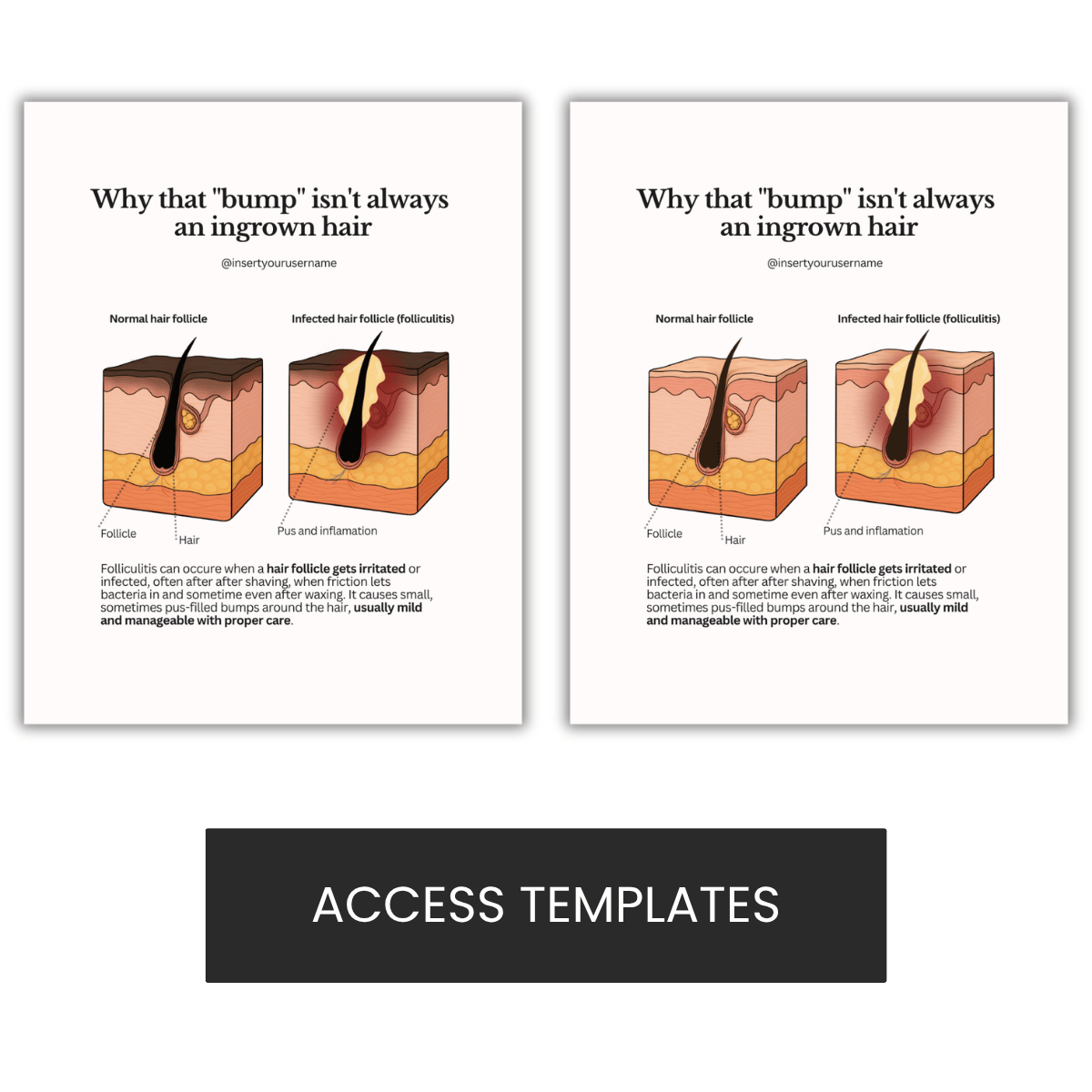 Why that "bump" isn't always  an ingrown hair Illustration