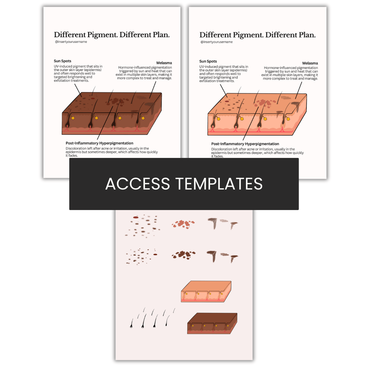 Pigment Illustration | Sun Spots | Melasma | PIH
