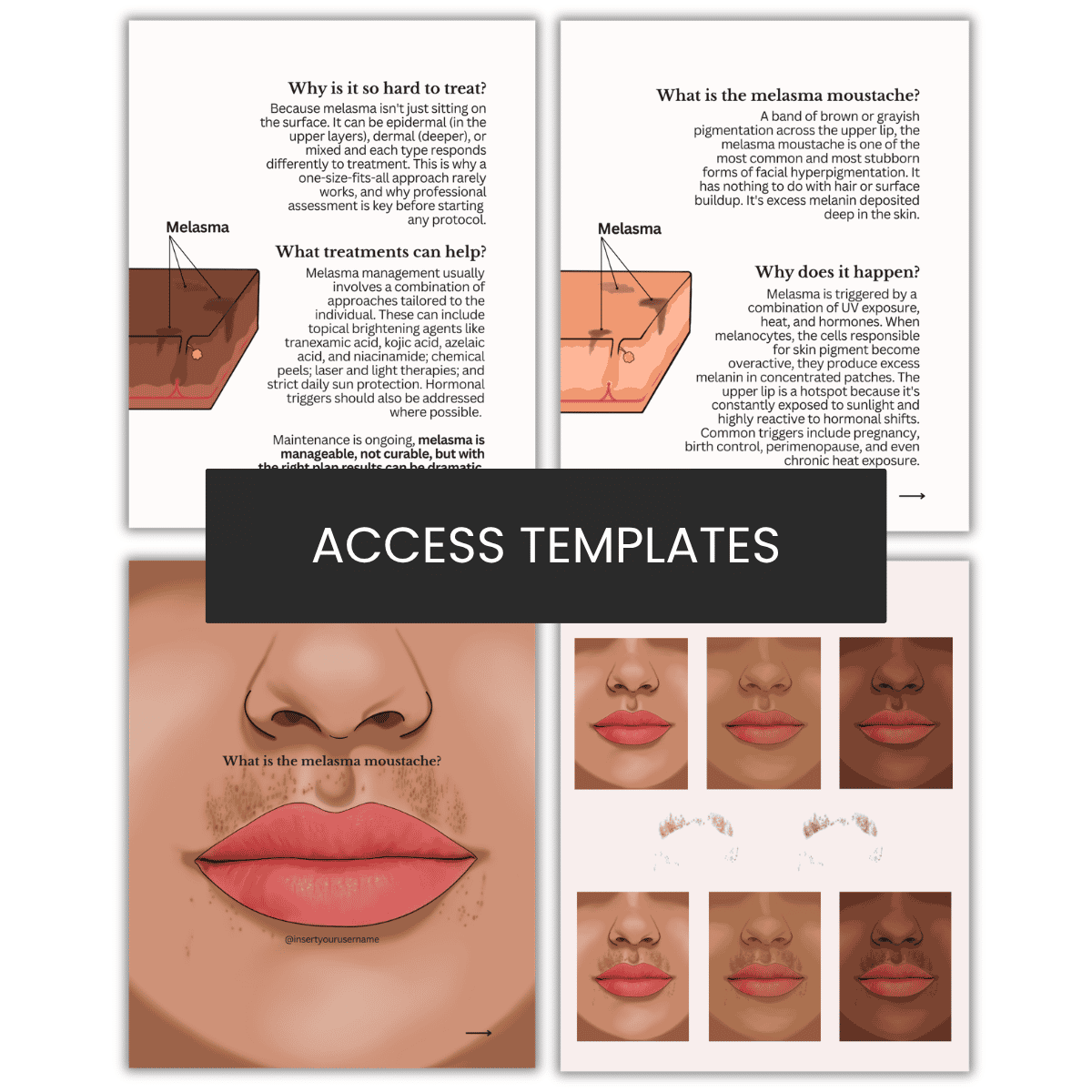Melasma Upper Lip Illustration