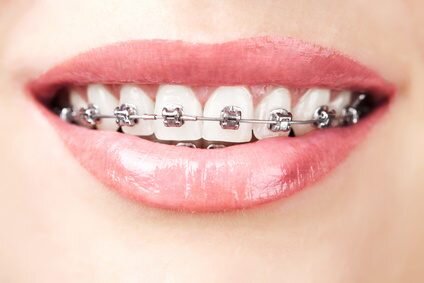 DAMON-BRACES-424x283.jpg