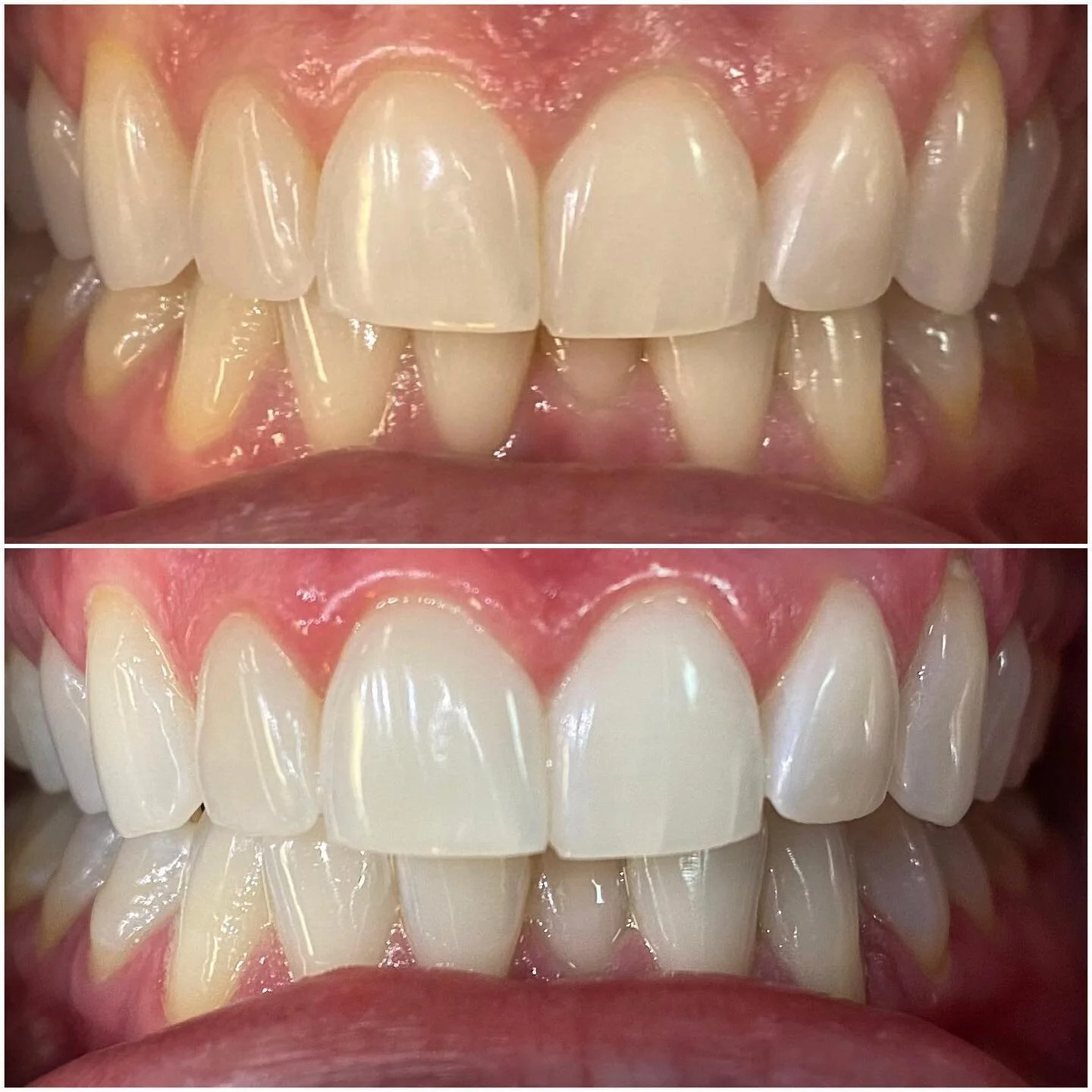 Teeth Whitening at The Saloon! 🦷 
&bull;
On special this week only! 
SPECIAL PRICE: $75
REGULAR PRICE: $125
&bull;
DM @tanned_by_ash to book your session today!