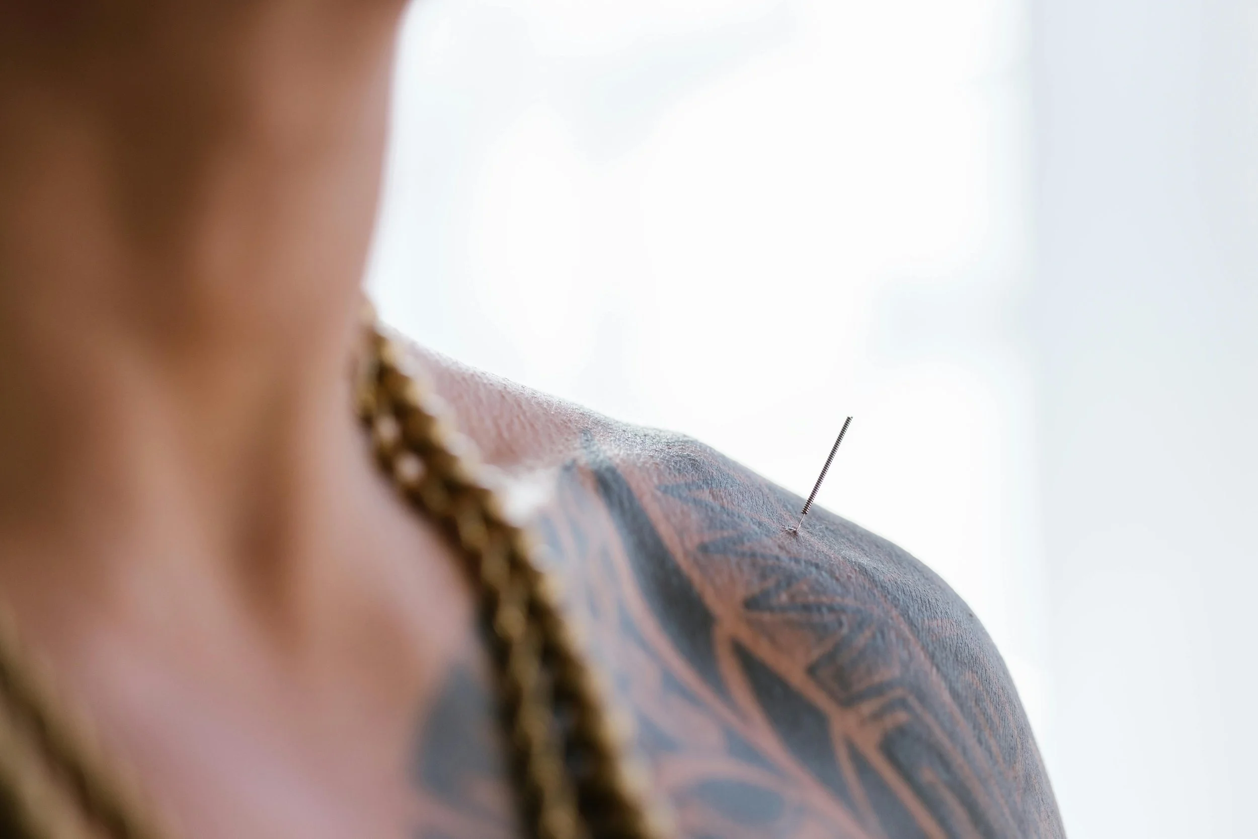 Acupuncture Treatment | Community Acupuncture | St Pete | Tampa