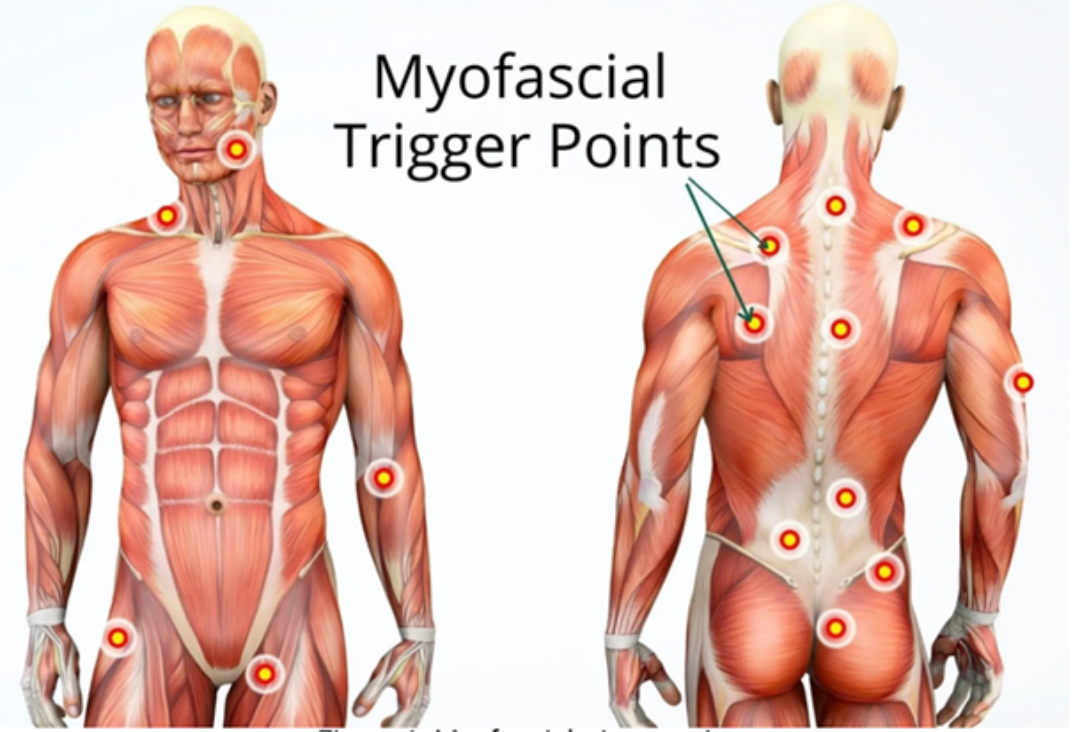 How Trigger Points Cause Referred Pain in Myofascial Pain Syndrome