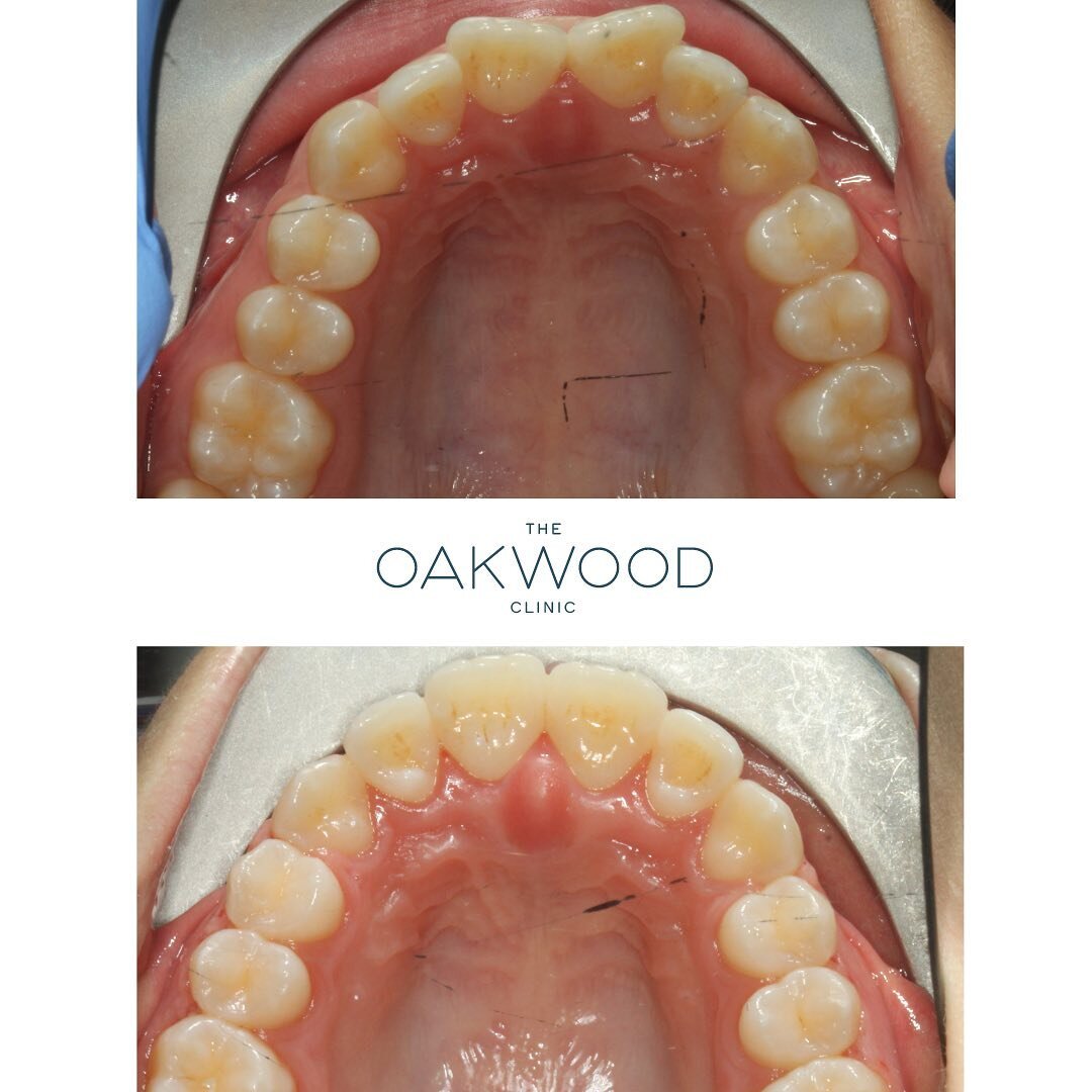 Sometimes, having crooked teeth is not the only reason our patients decide on a specific type of treatment. During our consultations, we take the time to talk to our patients and get to know them, which is very much part of the decision-making proces