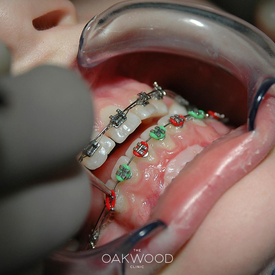 One of the many brace options available here at The Oakwood Clinic is the metal fixed brace. Considered as an OG in the market, they used to be big and bulky and unsightly, however, fixed brace technology has made huge strides of progress. Metal brac