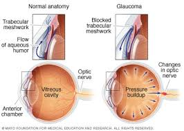 What are the Early Signs of Glaucoma? Risk Factors and Treatment Options