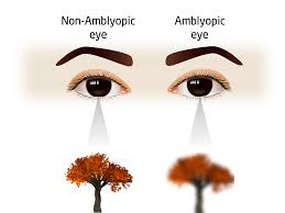 Amblyopia Treatment in Kew Gardens, NY: Expert Care for Lazy Eye