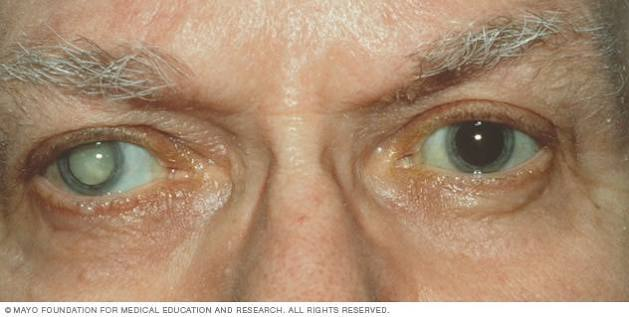 Understanding Cataracts: Causes, Symptoms, Diagnosis, and Treatment
