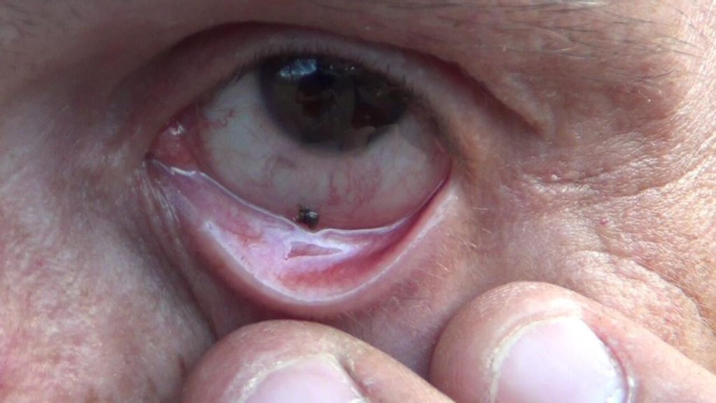Foreign Body in the Eye: What to Do and When to See an Eye Doctor in Kew Gardens, NY