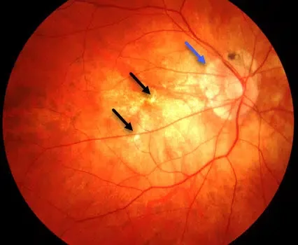 myopia under imaging with arrows