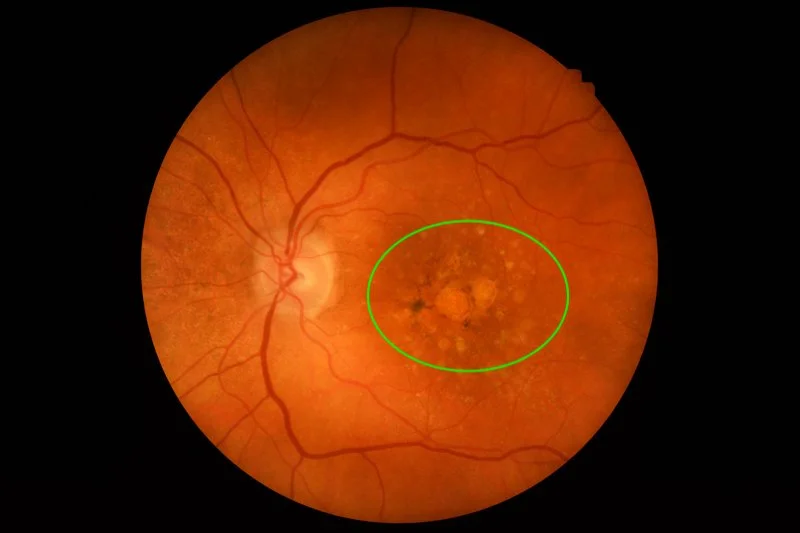 Dry Macular Degeneration retinal image circled.